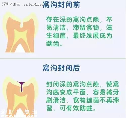 深圳(www.szxxg.com)二年级学生娃可免费做窝沟封闭 可预防龋齿哦