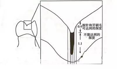 深圳(www.szxxg.com)二年级学生娃可免费做窝沟封闭 可预防龋齿哦