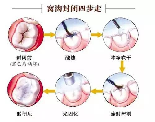 深圳(www.szxxg.com)二年级学生娃可免费做窝沟封闭 可预防龋齿哦